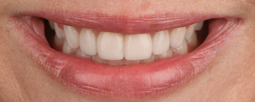 Close Up Smiles After Image 4 - Walden Dental