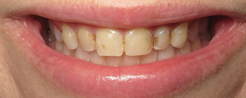 Close Up Smiles Before Image 4 - Walden Dental