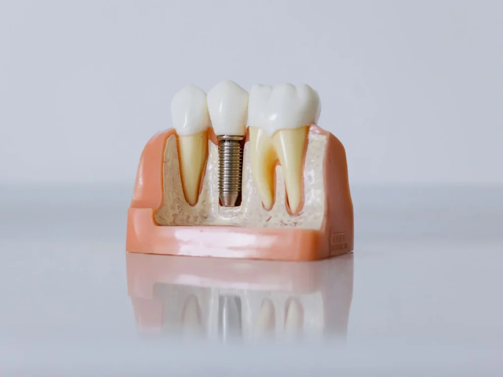 A dental implant model shows an artificial tooth and its screw-shaped support.