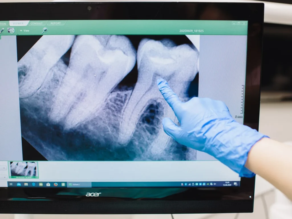 A gloved hand points to teeth on a dental X-ray displayed on a monitor.