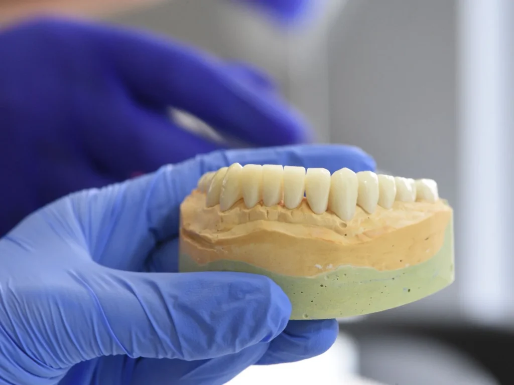 Gloved hands hold a dental cast showing the shape of the teeth.