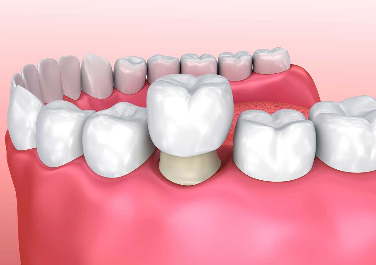 Dental crown placement on a prepared tooth