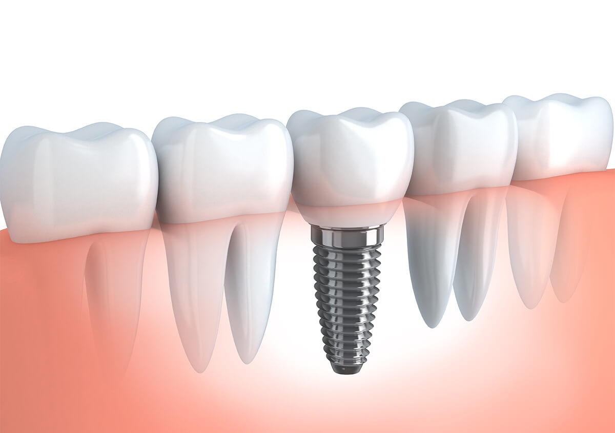 Dental implant with a crown replacing a natural tooth in a gum line.
