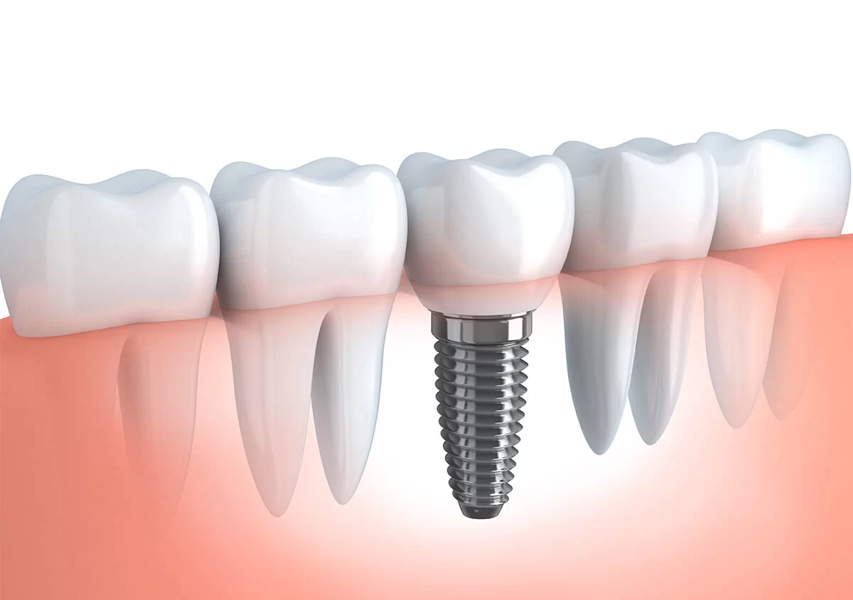 Dental implant with a crown replacing a natural tooth in a gum line.
