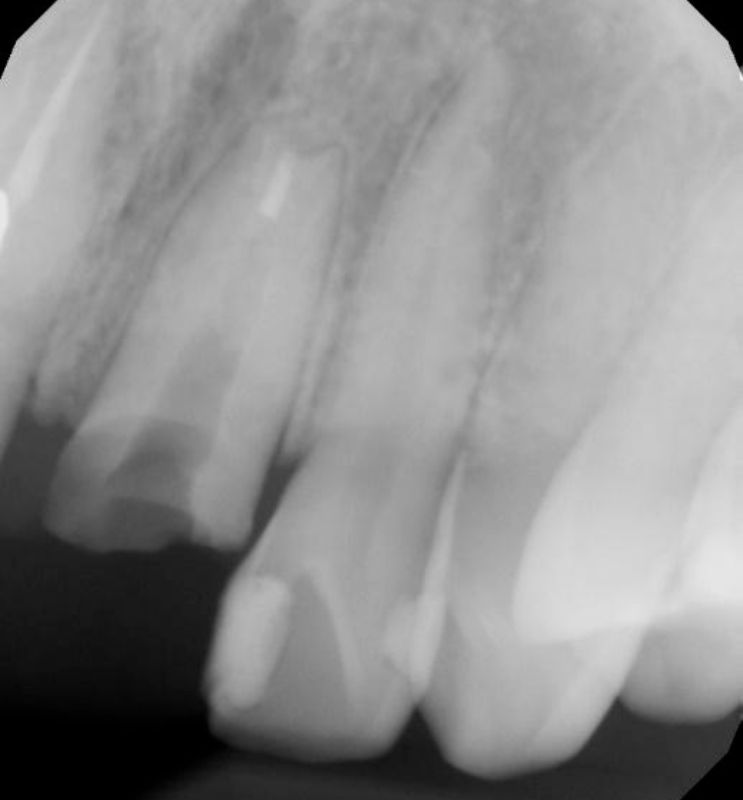 Cecilia dental Implant case image 3