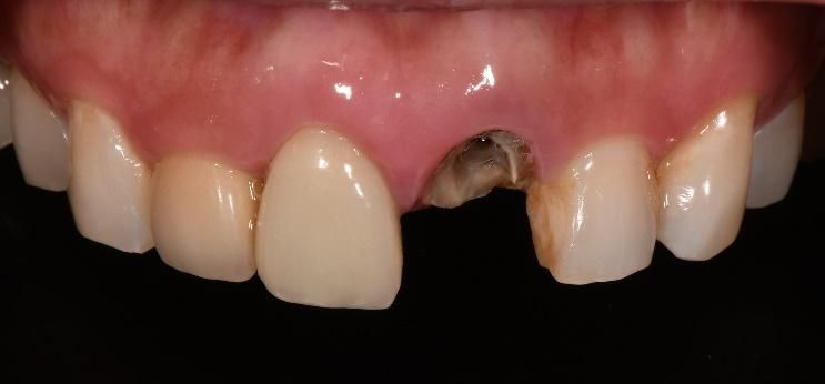 Cecilia dental Implant case image 2