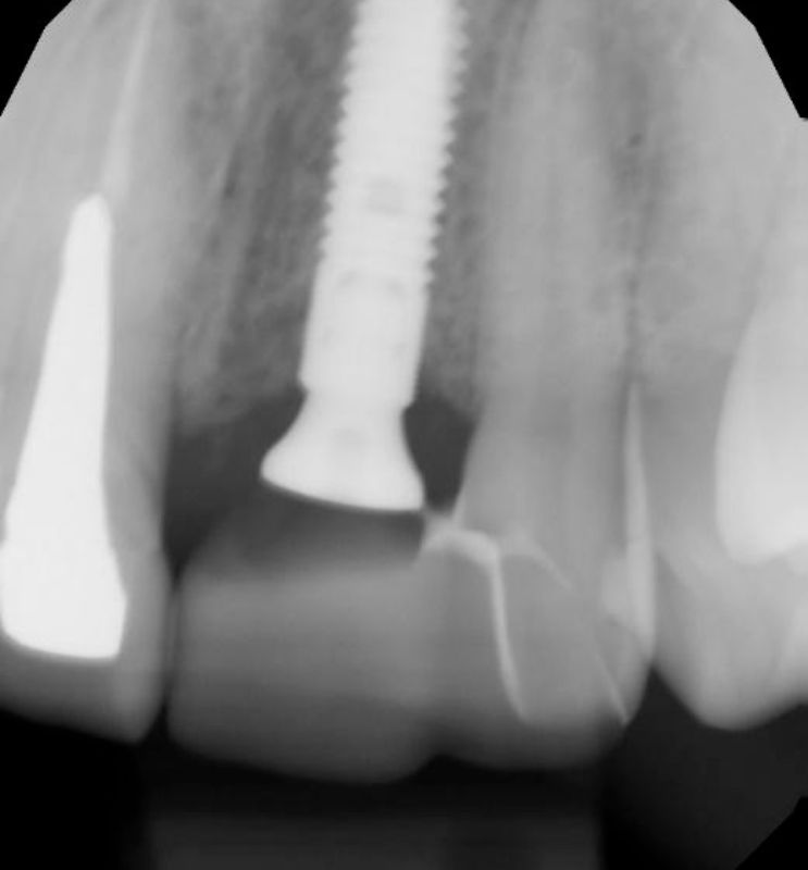 Cecilia dental Implant case image 4