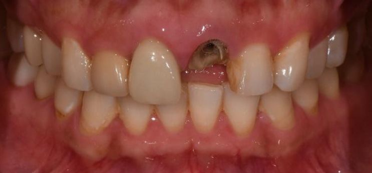 Cecilia dental Implant case image 1