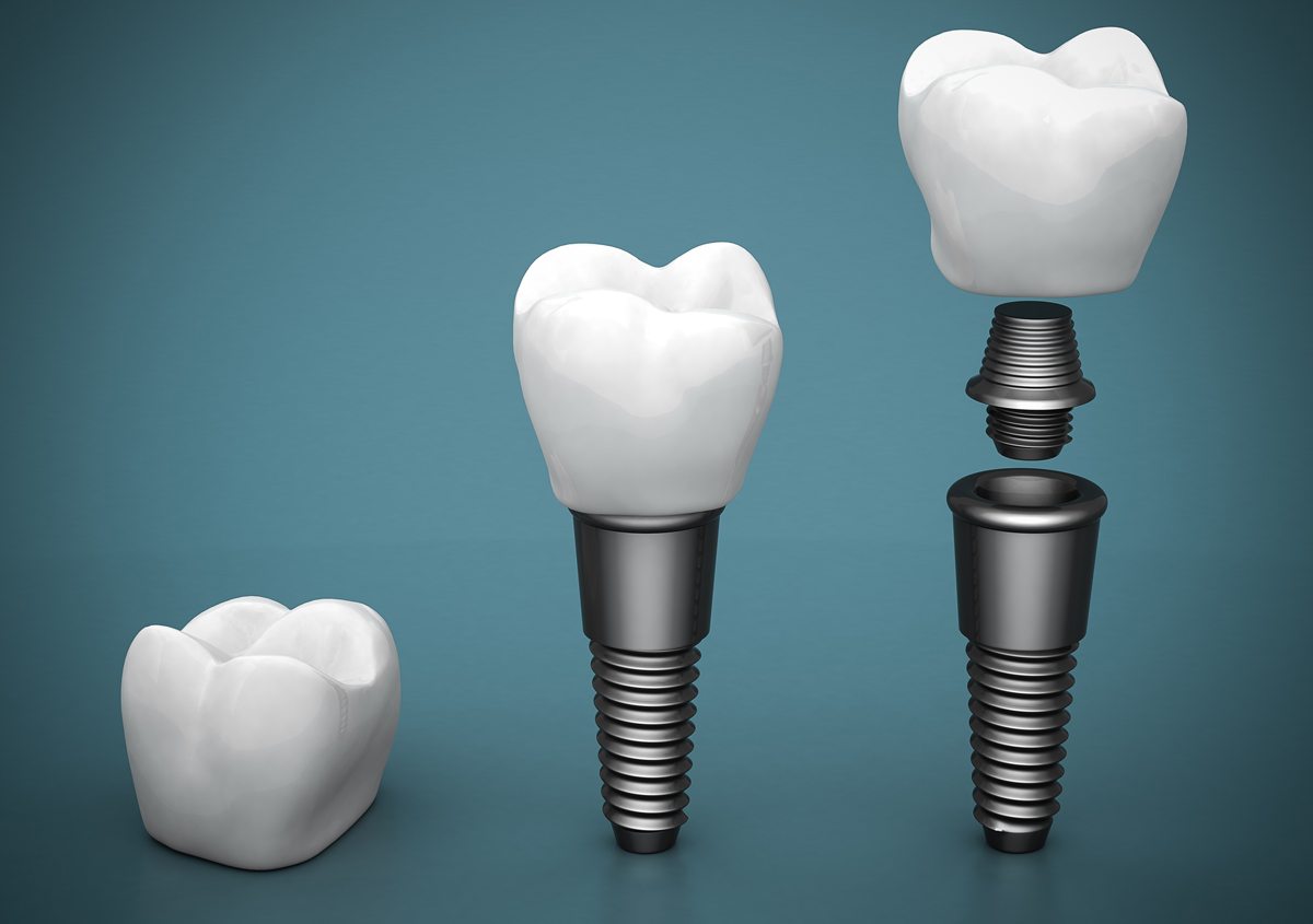 Affordable, High-Quality Dental Implants are a Phone Call Away!