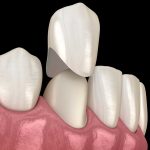 Same Day Crown Dentist in Austin Area