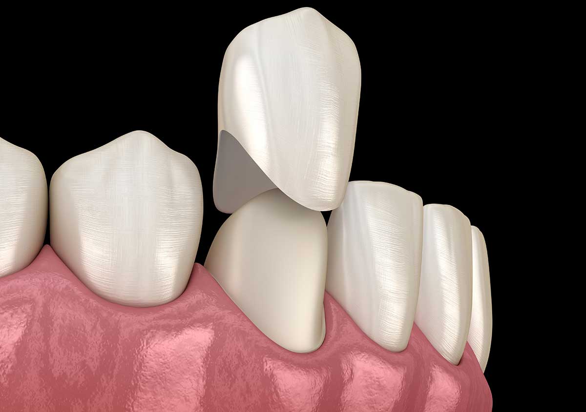 One-visit CEREC crowns that look beautiful and last