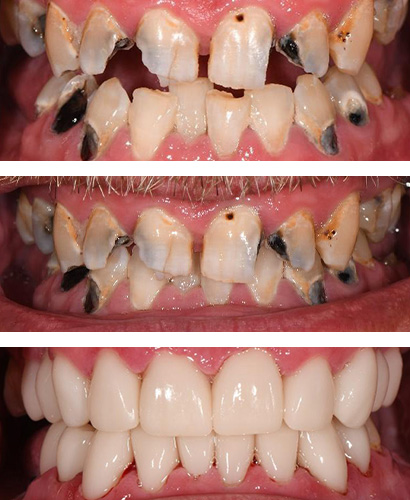 Blair, Before and After Treatment Dental Case 03