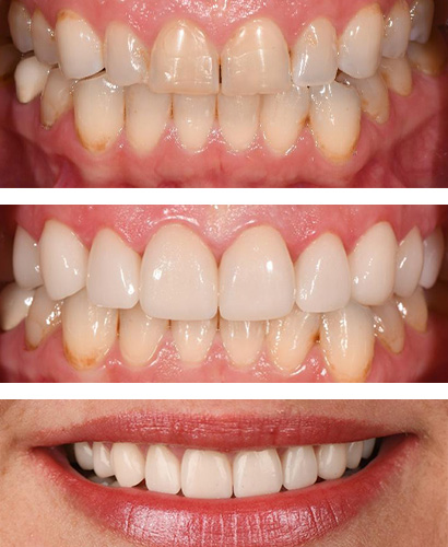 Buffy, Before and After Treatment Dental Case 05