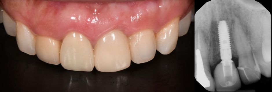 Cecilia dental Implant case image 6