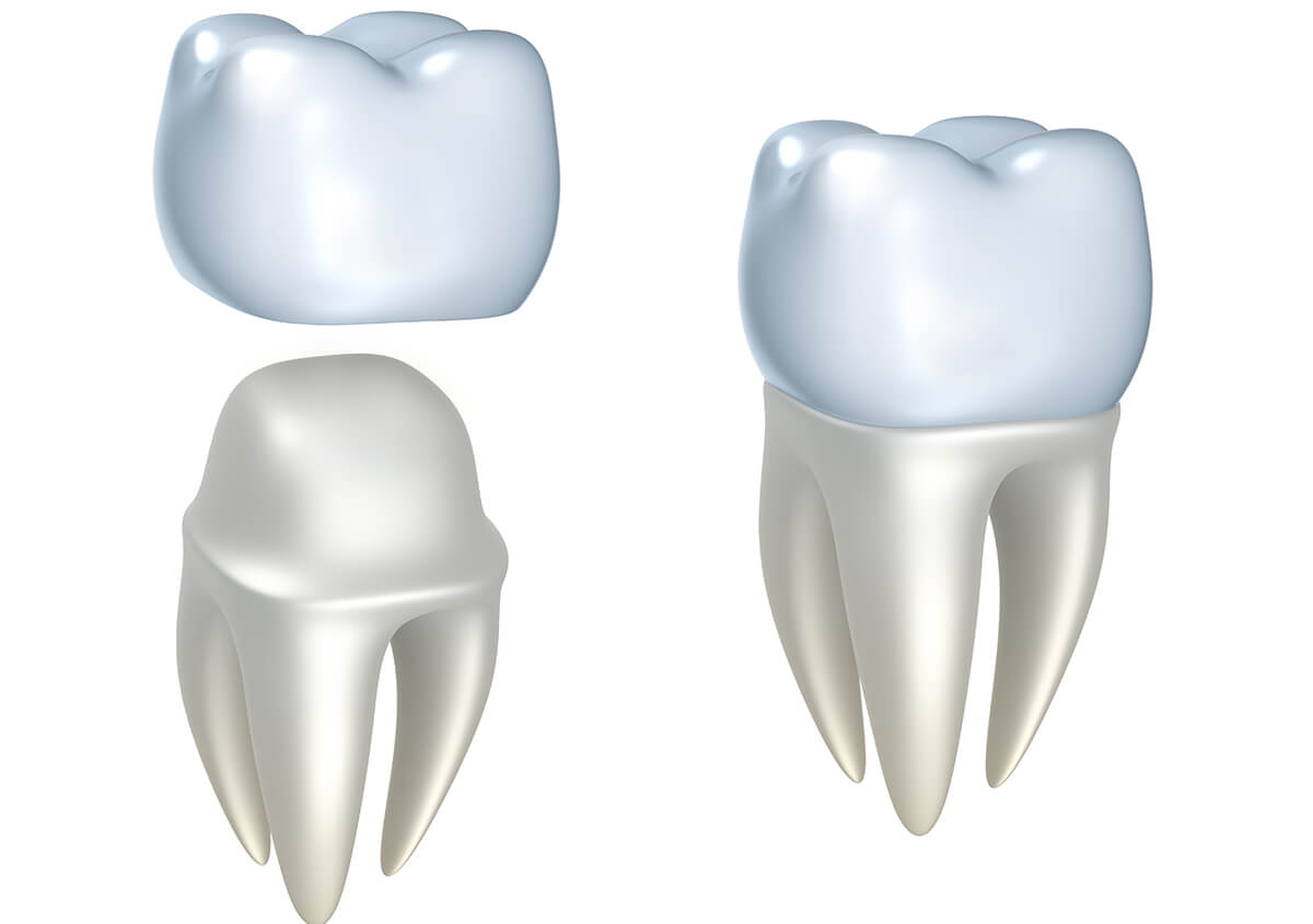 CEREC Same-Day Crowns