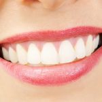 Dental Veneers for Front Teeth in Austin TX Area