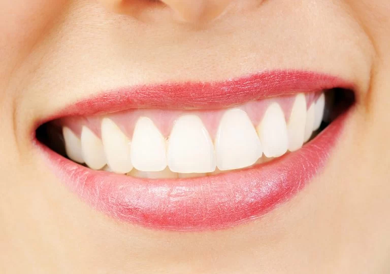 Dental Veneers for Front Teeth in Austin TX Area