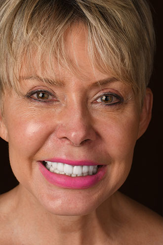 Full Face Smiles Image 02 - Walden Dental