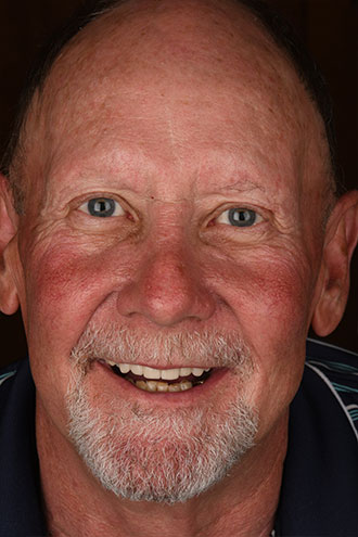 Full Face Smiles Image 09 - Walden Dental