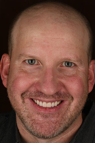 Full Face Smiles Image 10 - Walden Dental