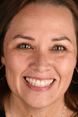 Full Face Smiles Image 12 - Walden Dental
