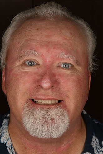 Full Face Smiles Image 14 - Walden Dental