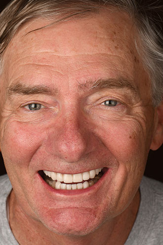 Full Face Smiles Image 16 - Walden Dental