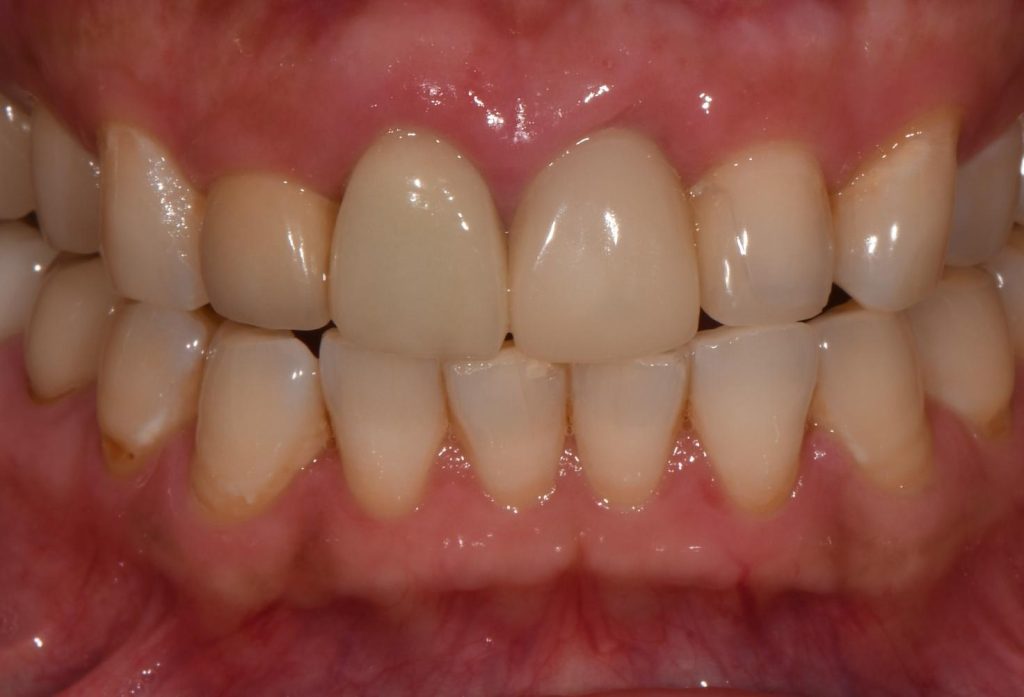 Cecilia dental Implant case image 7