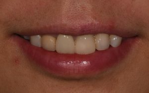 Cecilia dental Implant case image 5