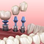 Implant Dentist in Austin Texas Area