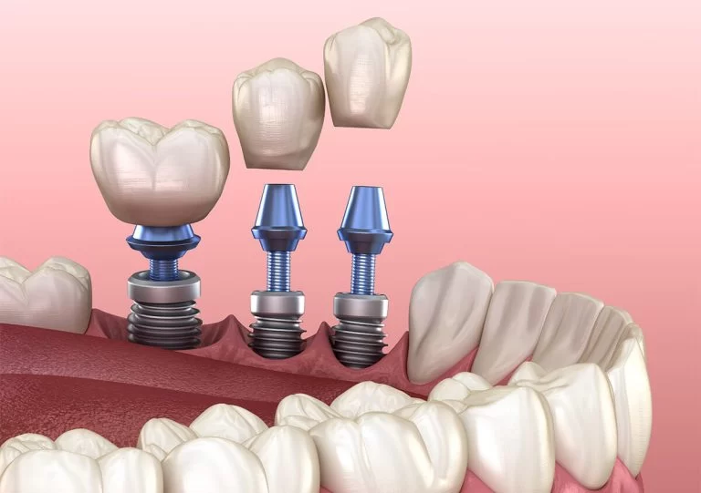 Implant Dentist in Austin Texas Area