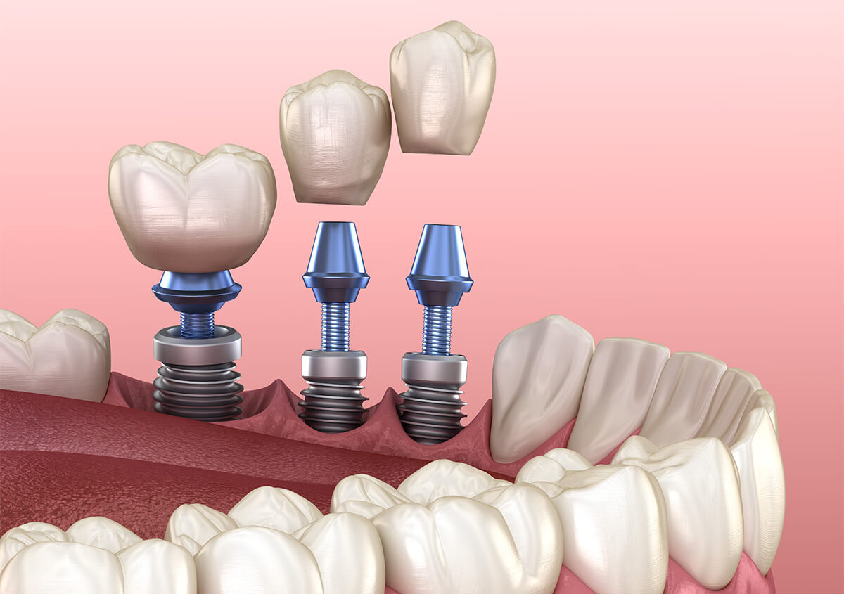 6 Things You Should Know Before Visiting an Implant Dentist in Austin, Texas