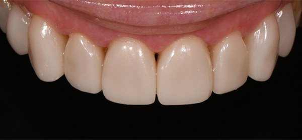 Lori, Before Treatment Dental Case 04