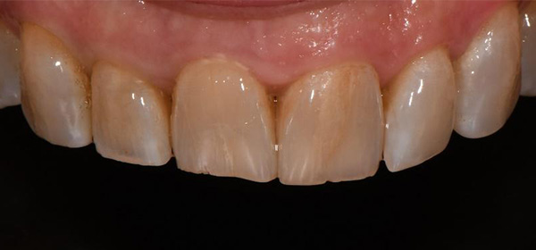 Lori, Before and After Treatment Dental Case 04