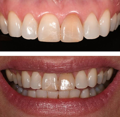 Maria, Before and After Treatment Dental Case 03