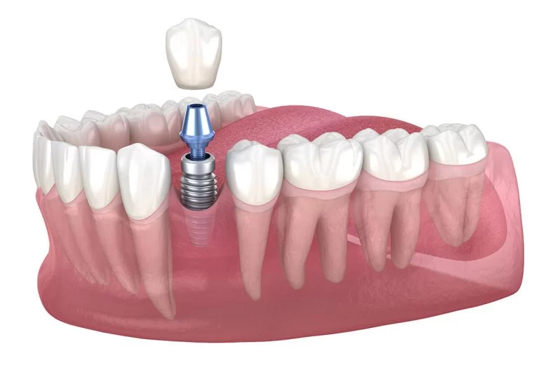 Missing Teeth Solutions in Austin TX Area