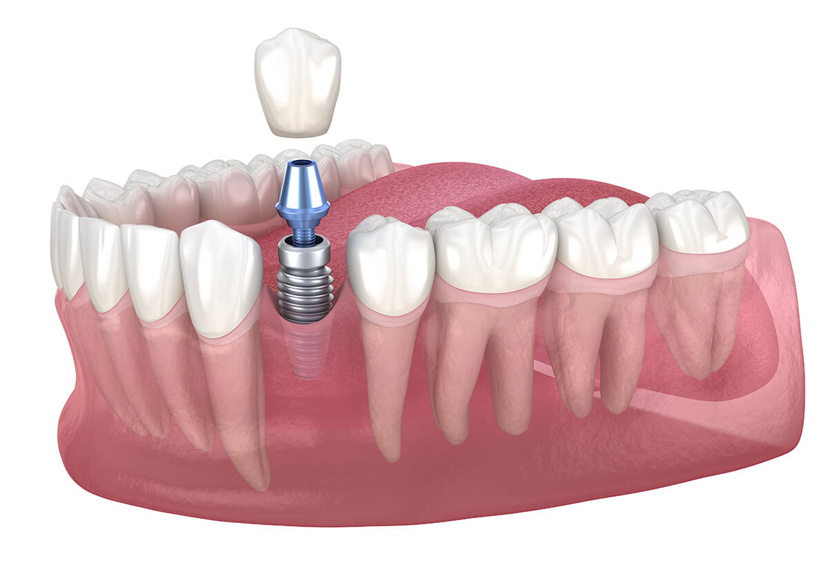 5 Reasons You Should Consider Dental Implants to Replace Missing Teeth