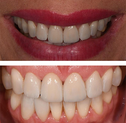 Nikki, After Treatment Dental Case 02
