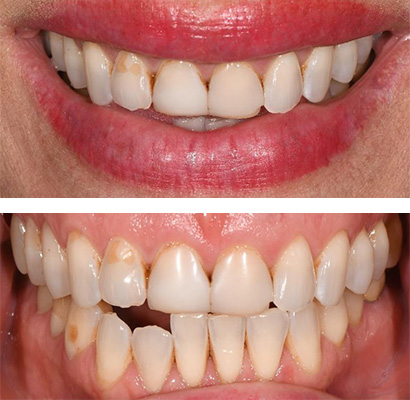 Nikki, Before Treatment Dental Case 02