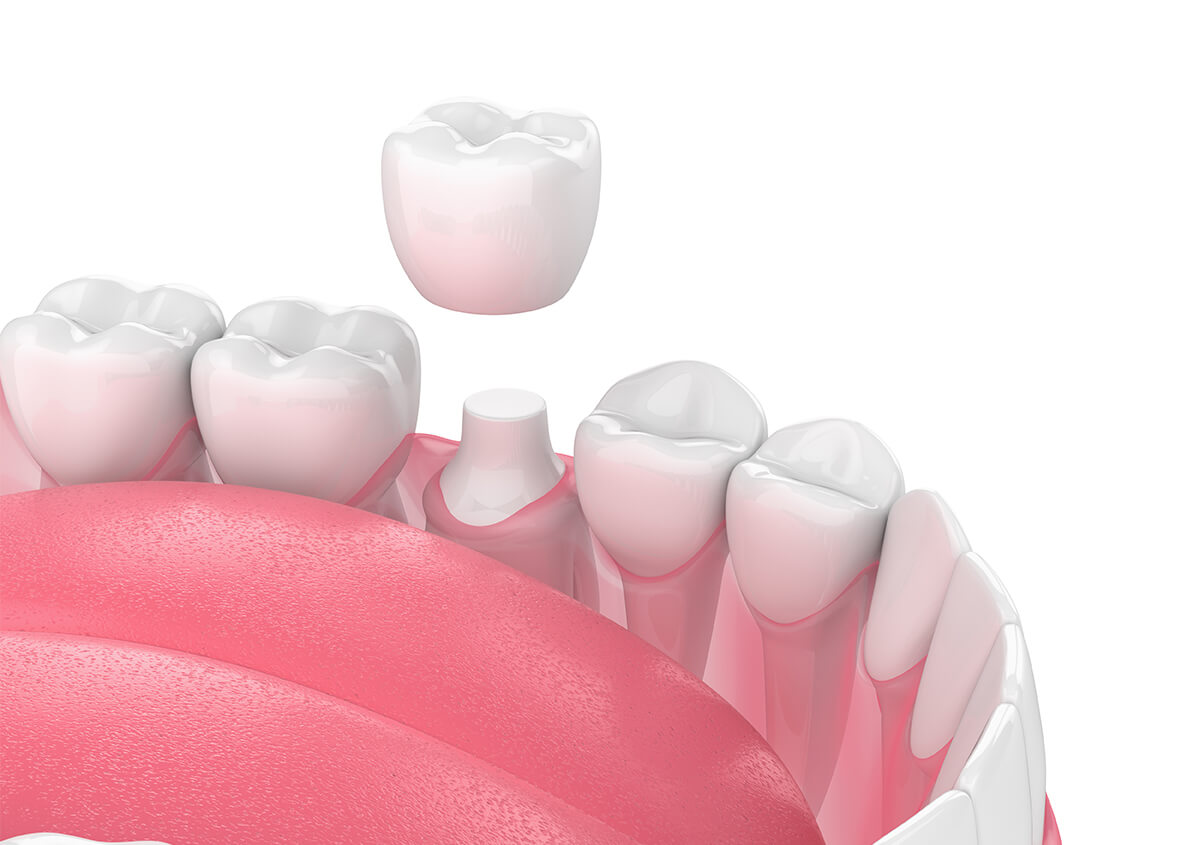 The beauty, ease, and strength of metal-free dental crowns made in one visit, without the wait