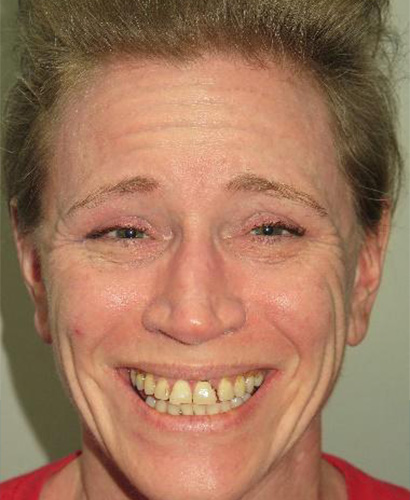 Sara, Before Treatment Dental Case 04