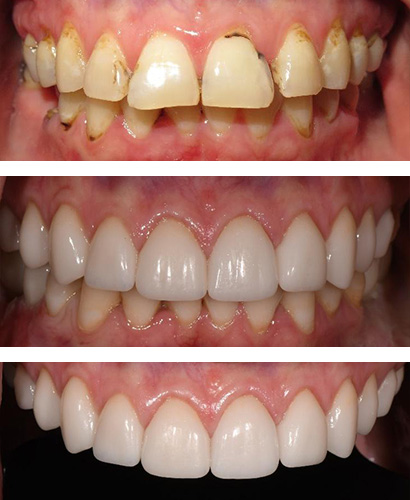 Sara, Before and After Treatment Dental Case 01