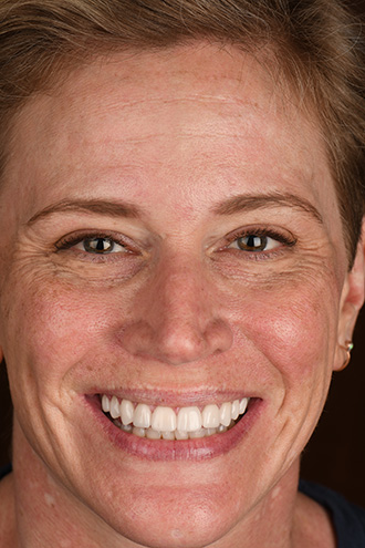 Full Face Smiles Image 23 - Walden Dental