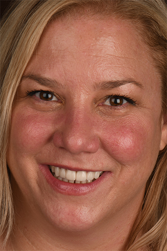 Full Face Smiles Image 24 - Walden Dental