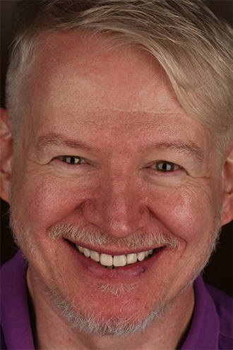 Full Face Smiles Image 25 - Walden Dental