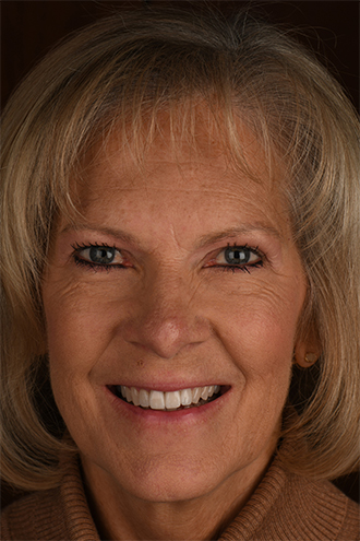 Full Face Smiles Image 26 - Walden Dental