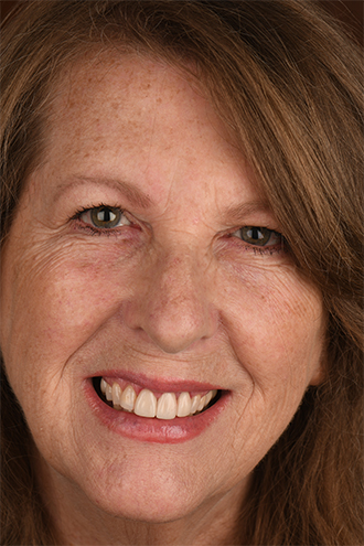 Full Face Smiles Image 28 - Walden Dental