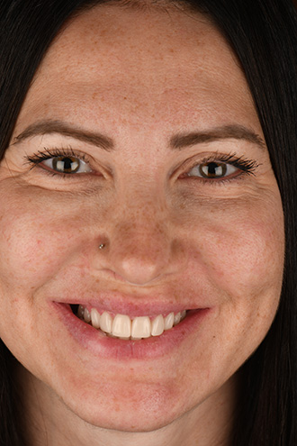 Full Face Smiles Image 31 - Walden Dental