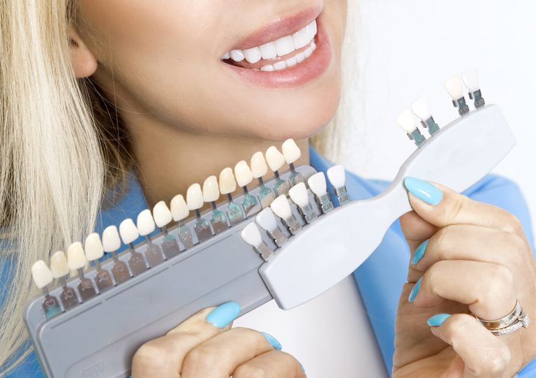 Veneers Cost in Austin TX Area