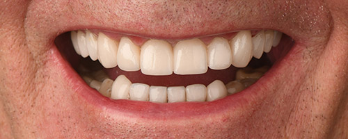 Close Up Smiles After Image 1 - Walden Dental